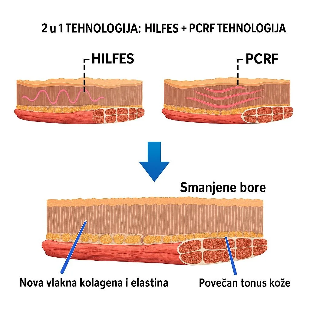 Delux Face M - Tretmani HILFES i PCRF tehnologijom - Petrinja - Sisak